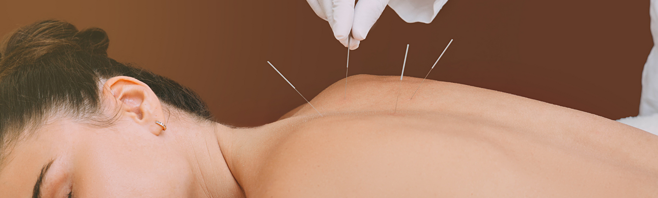 Acupuncture