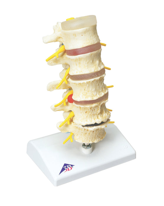 3B Scientific Anatomical Model - Prolapsed disc