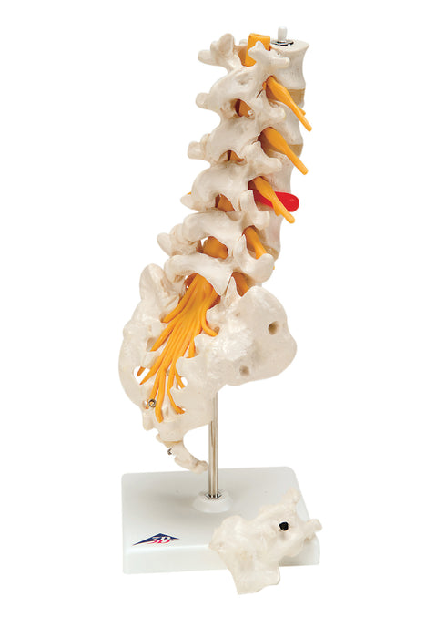 3B Scientific Anatomical Model - Prolapsed disc