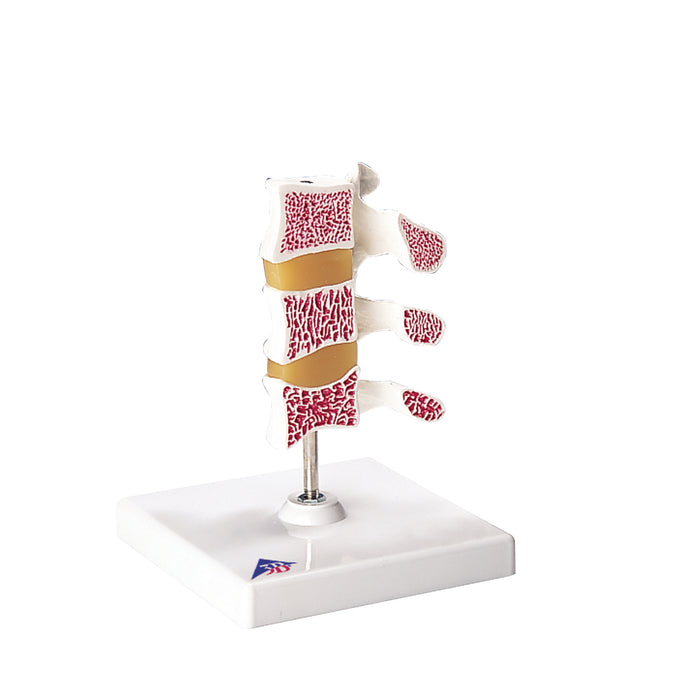 3B Scientific Anatomical Model - Deluxe Osteoporosis Model (3 Vertebrae)